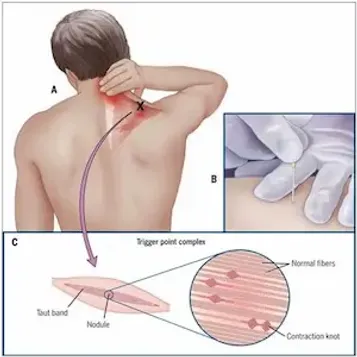 dry needling tehnika, manuelna terapija pravdic-beograd